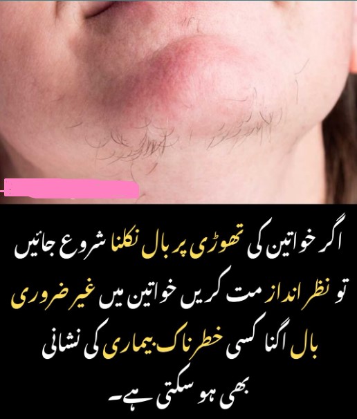 Unwanted hair growth in women – Sign of a dangerous disease
